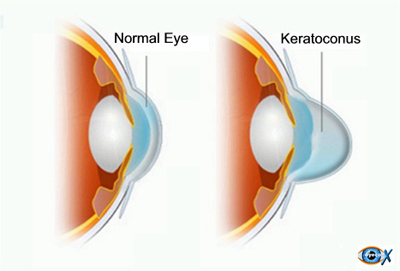 Keratoconus - cum si unde ne tratam de keratocon?